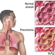 pneumonia is it contagious